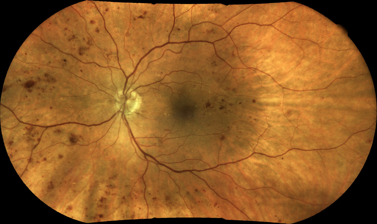 Digital image of diabetic retinopathy