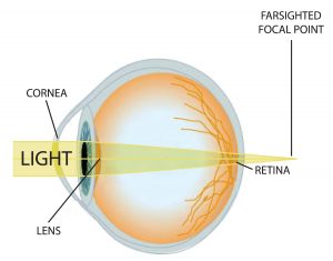 Image of a hyperopic eye