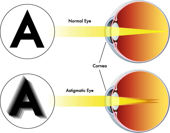 image of an eye with astigmatism