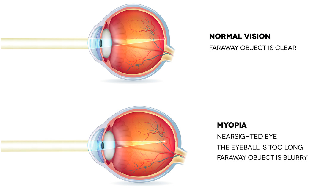 Image of a myopic eye