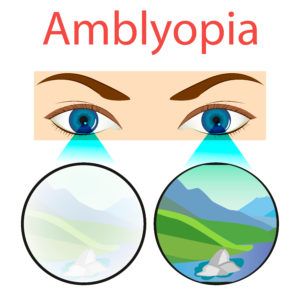 Amblyopia Crestwood Eye Care